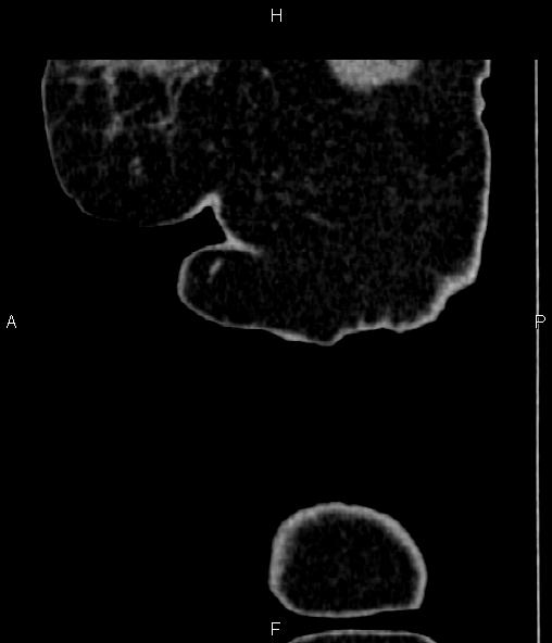Adrenal myelolipoma (Radiopaedia 82742-96986 Sagittal renal cortical phase 3).jpg