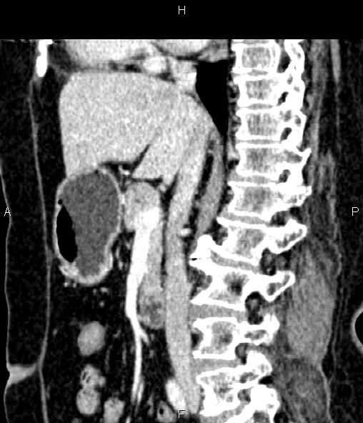 Adrenal myelolipoma (Radiopaedia 82742-96986 Sagittal renal cortical phase 53).jpg
