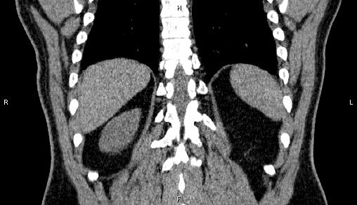 Adrenal myelolipoma (Radiopaedia 84321-99619 Coronal non-contrast 64).jpg