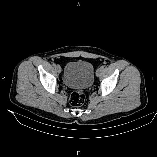 Adrenal myelolipoma (Radiopaedia 87794-104246 Axial non-contrast 94).jpg