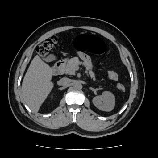 Adrenal myelolipoma and beaver tail liver (Radiopaedia 86201-102193 Axial non-contrast 169).jpg