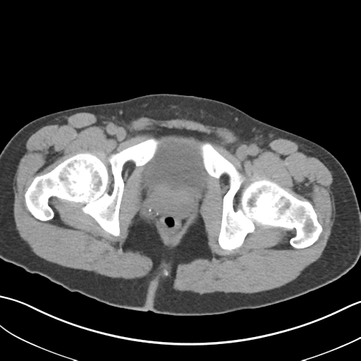 File:Adult polycystic kidney disease (Radiopaedia 47866-52626 Axial non-contrast 84).png