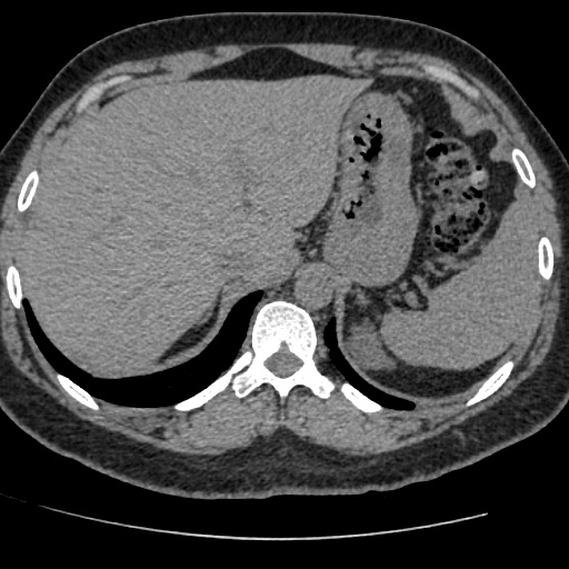 Adult polycystic kidney disease (Radiopaedia 59075-66368 Axial non-contrast 4).jpg