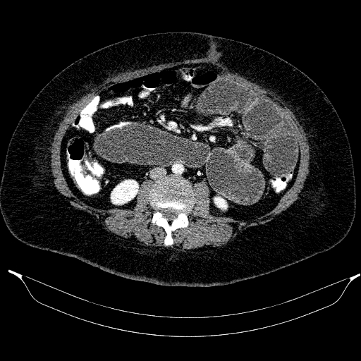 Afferent loop syndrome - secondary to incarcerated trocar site hernia (Radiopaedia 82959-97305 Axial C+ portal venous phase 122).jpg
