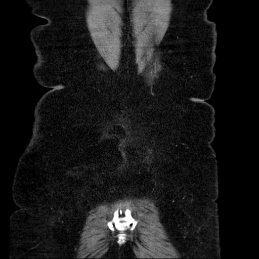 File:Afferent loop syndrome - secondary to incarcerated trocar site hernia (Radiopaedia 82959-97305 Coronal C+ portal venous phase 133).jpg