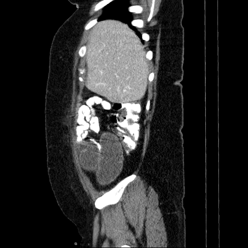File:Afferent loop syndrome - secondary to incarcerated trocar site hernia (Radiopaedia 82959-97305 Sagittal C+ portal venous phase 131).jpg