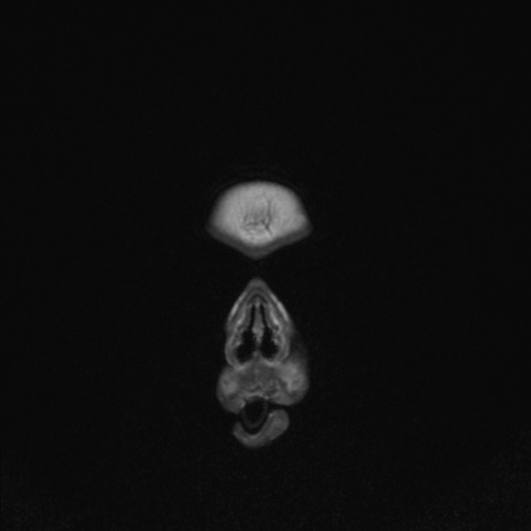 Agenesis of the corpus callosum (Radiopaedia 23491-23578 Coronal T1 8).jpg