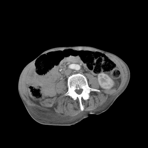 Aggressive lung cancer with cardiac metastases, pulmonary artery tumor thrombus, and Budd-Chiari (Radiopaedia 60320-67981 A 77).jpg