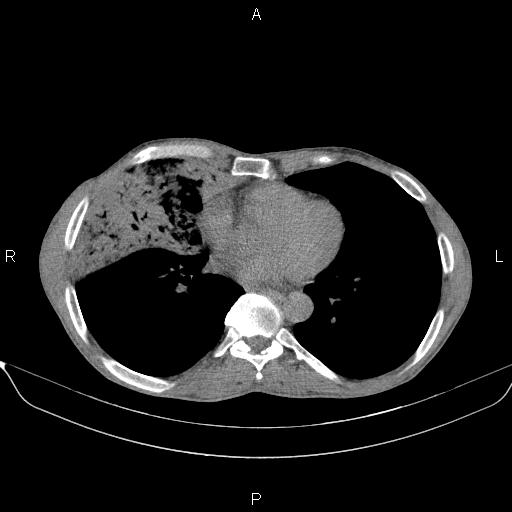 Air bronchogram in pneumonia (Radiopaedia 85719-101512 Axial non-contrast 42).jpg