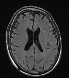 File:Alzheimer's disease- with apraxia (Radiopaedia 54763-61011 Axial FLAIR 17).png