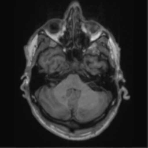 File:Alzheimer's disease- with apraxia (Radiopaedia 54763-61011 Axial T1 18).png