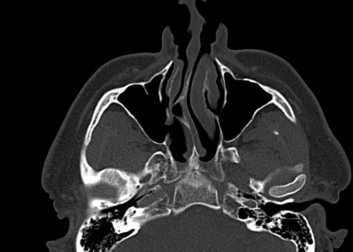 Ameloblastoma (Radiopaedia 38520-40623 D 14).png