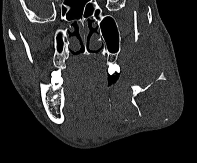 Ameloblastoma (Radiopaedia 51921-57766 Coronal bone window 107).jpg