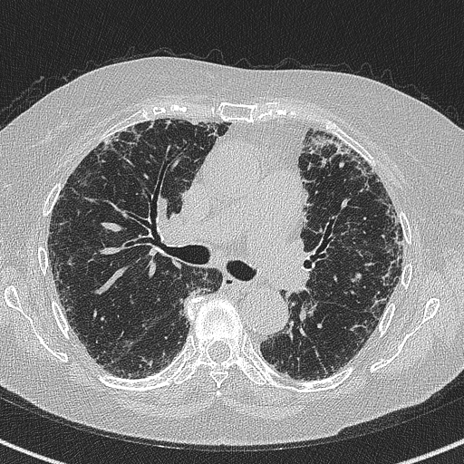 Amiodarone-induced pulmonary fibrosis (Radiopaedia 82355-96460 Axial lung window 30).jpg