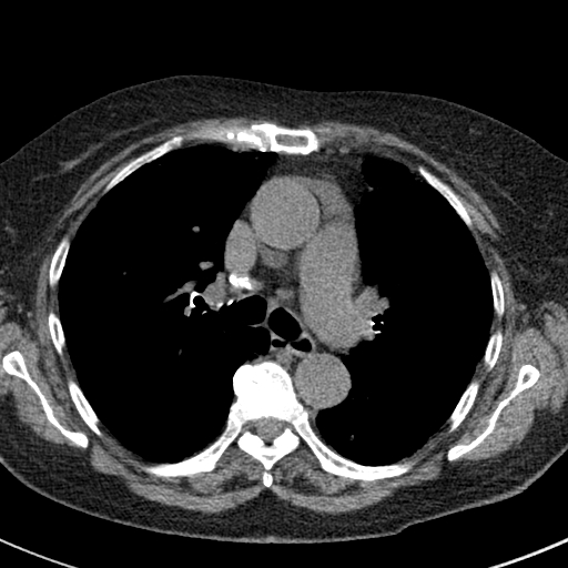 File:Amiodarone-induced pulmonary fibrosis (Radiopaedia 82355-96460 Axial non-contrast 27).jpg