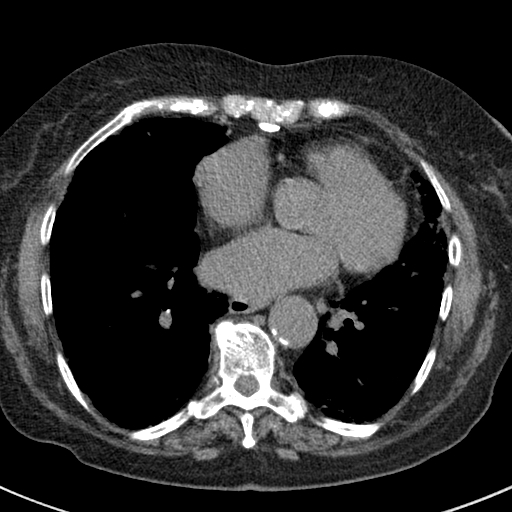 File:Amiodarone-induced pulmonary fibrosis (Radiopaedia 82355-96460 Axial non-contrast 39).jpg