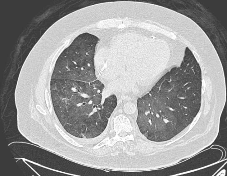 File:Amiodarone lung (Radiopaedia 62514-70769 Axial lung window 60).jpg