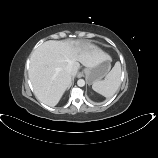 File:Amoebic liver abscess (Radiopaedia 52611-58530 A 17).png