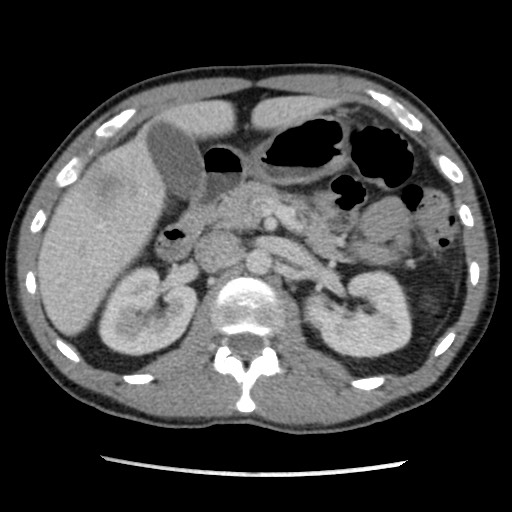 File:Amoebic liver abscesses (Radiopaedia 55536-62009 A 35).jpg