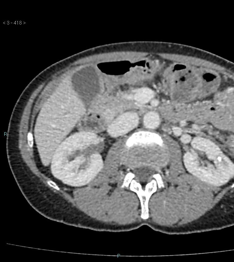 Ampulla of Vater metastasis (Radiopaedia 27820-28065 A 22).jpg