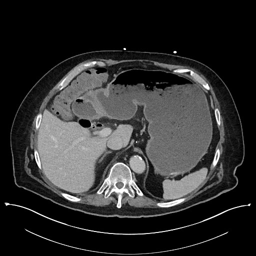 Ampullary adenocarcinoma (Radiopaedia 59373-66737 A 42).jpg