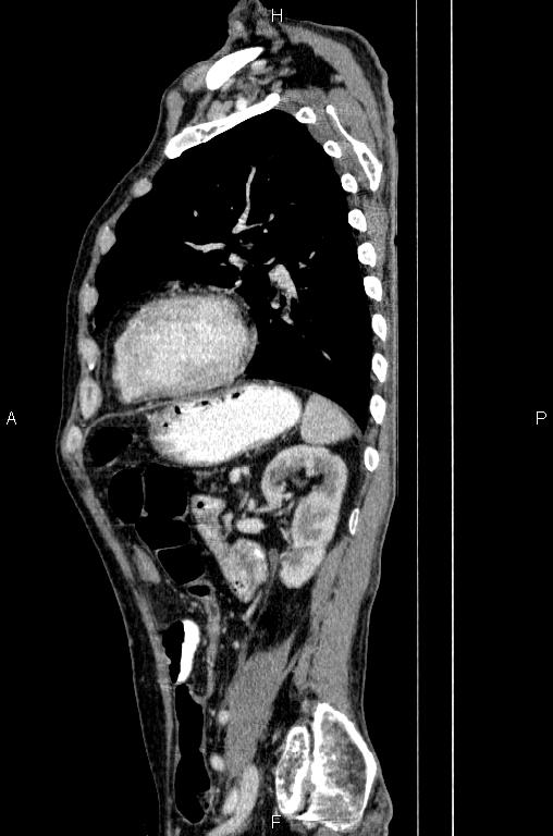 Ampullary adenocarcinoma (Radiopaedia 86093-102033 E 65).jpg