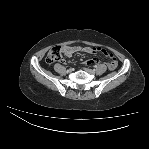Ampullary tumor (Radiopaedia 60333-67998 A 63).jpg