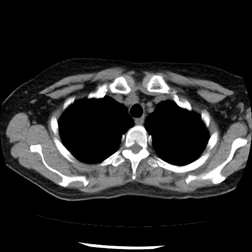 File:Amyloidosis - bronchial and diffuse nodular pulmonary involvement (Radiopaedia 60156-67744 Axial non-contrast 11).jpg
