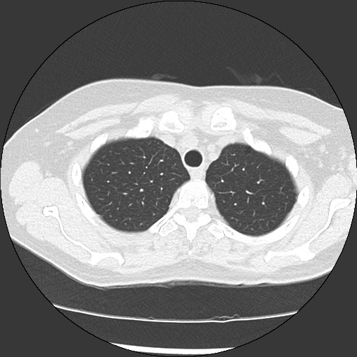 Amyloidosis - bronchial and diffuse nodular pulmonary involvement (Radiopaedia 60156-67744 B 11).jpg