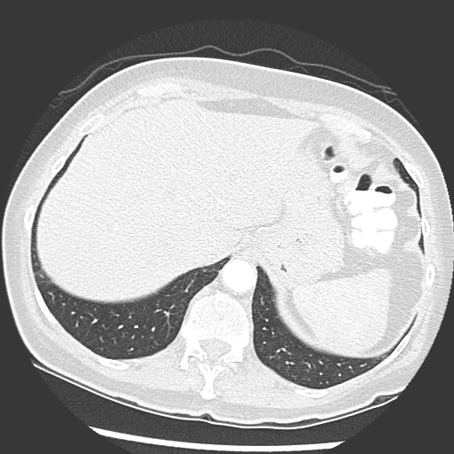 Amyloidosis - bronchial and diffuse nodular pulmonary involvement (Radiopaedia 60156-67745 Axial lung window 76).jpg