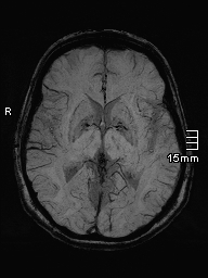 File:Amyotrophic lateral sclerosis (Radiopaedia 70821-81017 Axial SWI minIP 22).jpg