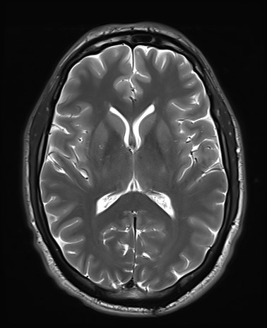 File:Amyotrophic lateral sclerosis (Radiopaedia 87352-103658 Axial T2 15).jpg