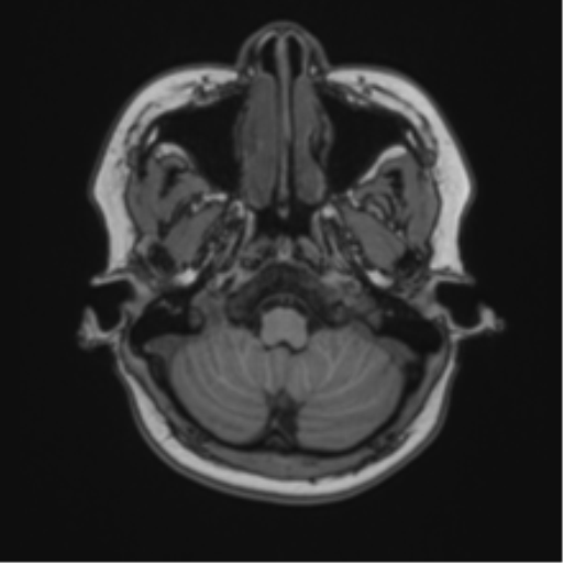 Anaplastic astroblastoma (Radiopaedia 55666-62194 Axial T1 12).png
