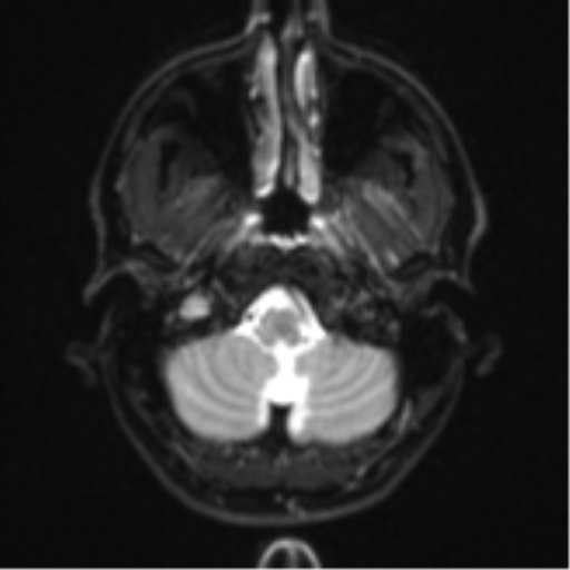 Anaplastic astrocytoma (Radiopaedia 57768-64731 Axial DWI 3).png