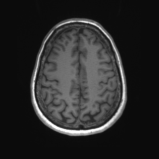 File:Anaplastic astrocytoma - thalamic glioma (Radiopaedia 59709-67115 Axial T1 31).png