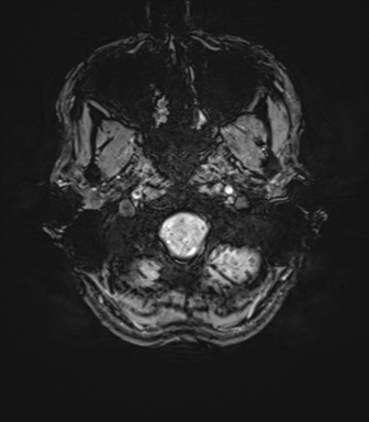 File:Anaplastic astrocytoma IDH mutant (Radiopaedia 50046-55341 Axial SWI 9).png