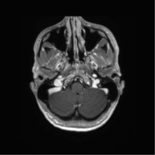 File:Anaplastic astrocytoma IDH mutant (Radiopaedia 50046-55341 Axial T1 C+ 9).png
