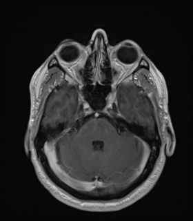 File:Anaplastic astrocytoma IDH wild-type (Radiopaedia 49984-55273 Axial T1 C+ 18).png