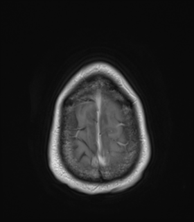 File:Anaplastic astrocytoma IDH wild-type (Radiopaedia 49984-55273 Axial T1 C+ 52).png