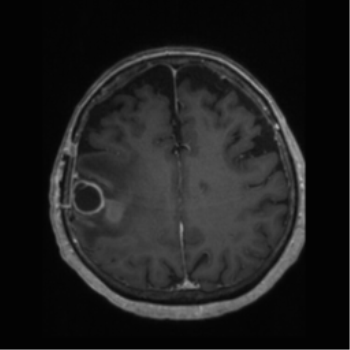 File:Anaplastic astrocytoma IDH wild-type (pseudoprogression) (Radiopaedia 42209-45277 Axial T1 C+ 86).png