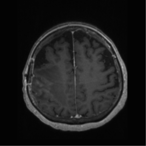 File:Anaplastic astrocytoma IDH wild-type (pseudoprogression) (Radiopaedia 42209-45277 Axial T1 C+ 93).png