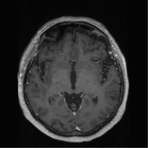 File:Anaplastic astrocytoma IDH wild-type (pseudoprogression) (Radiopaedia 42209-45278 Axial T1 C+ 76).png