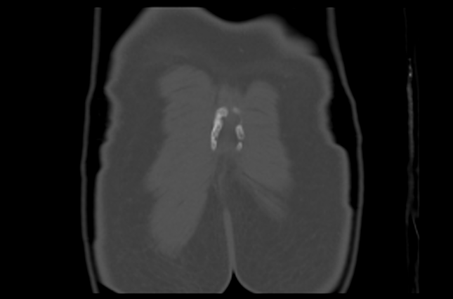 File:Aneurysmal bone cyst of ischium (Radiopaedia 25957-26094 Coronal bone window 47).png