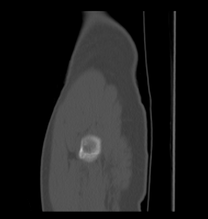 Aneurysmal bone cyst of ischium (Radiopaedia 25957-26094 Sagittal bone window 72).png