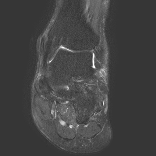 File:Aneurysmal bone cyst of the calcaneus (Radiopaedia 60669-68420 Coronal T2 fat sat 6).jpg