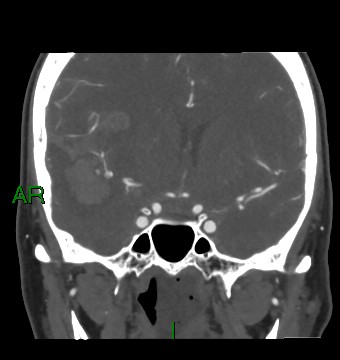 Aneurysmal subarachnoid hemorrhage with intra-axial extension (Radiopaedia 84371-99732 C 60).jpg