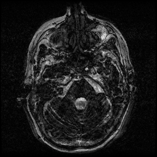 Angioinvasive aspergillosis in the pituitary fossa (Radiopaedia 39676-42010 Ax 3D FIESTA VOLUME 22).png