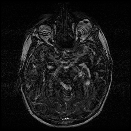 Angioinvasive aspergillosis in the pituitary fossa (Radiopaedia 39676-42010 Ax 3D FIESTA VOLUME 66).png