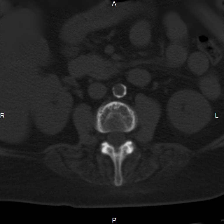Ankylosing spondylitis (Radiopaedia 8748-9556 Axial bone window 29).jpg