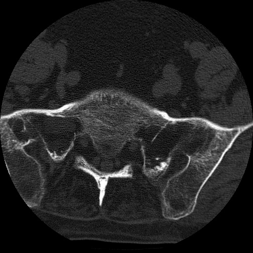 File:Ankylosing spondylitis complicated by fracture-dislocation (Radiopaedia 33583-34674 Axial non-contrast 157).jpg
